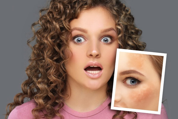 Dermamelan / Cosmelan