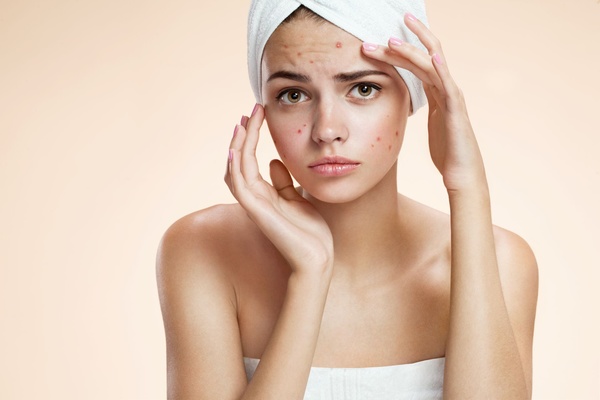 Chemical peels