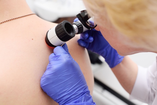 Dermatoscopy
