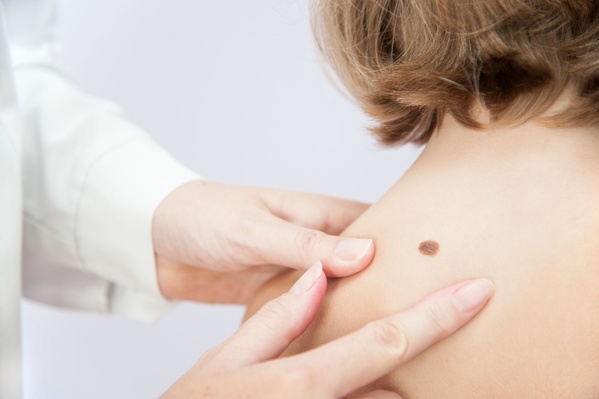 Surgical excision of skin lesion