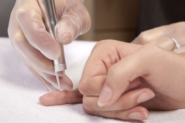 Kurzajki - brodawki wirusowe